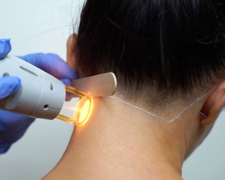 DEPILACIÓN LÁSER CUELLO