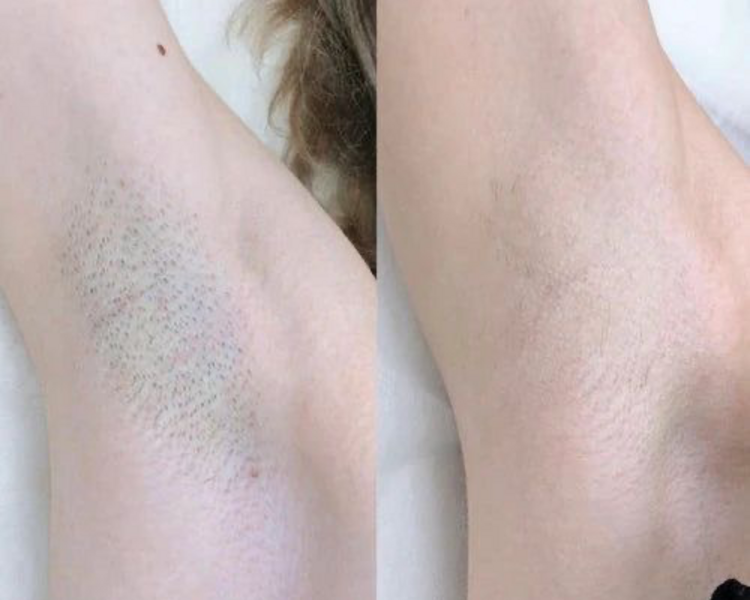 DEPILACIÓN LÁSER AXILAS