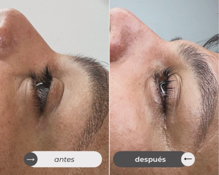 PERFILADO+LIFTING+LAMINADO