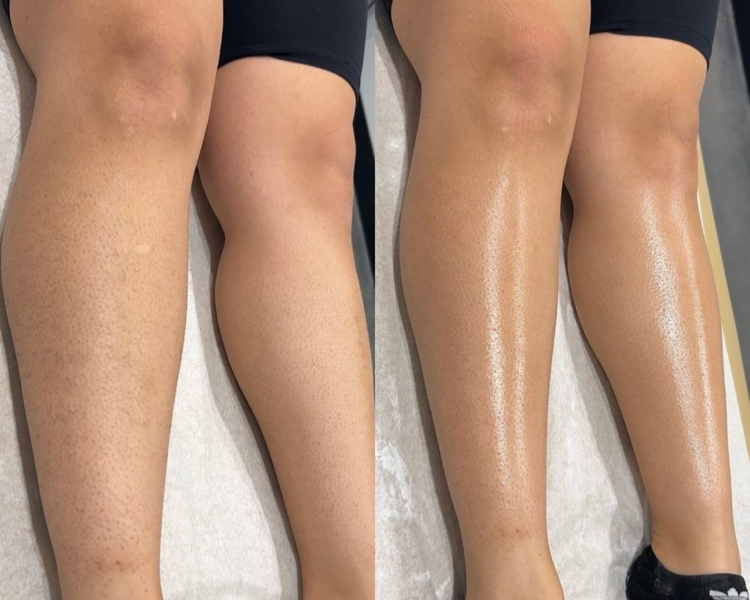 DEPILACIÓN LÁSER PIERNAS COMPLETAS