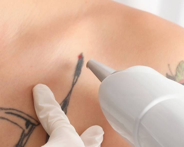 ELIMINACIÓN DE TATUAJE 