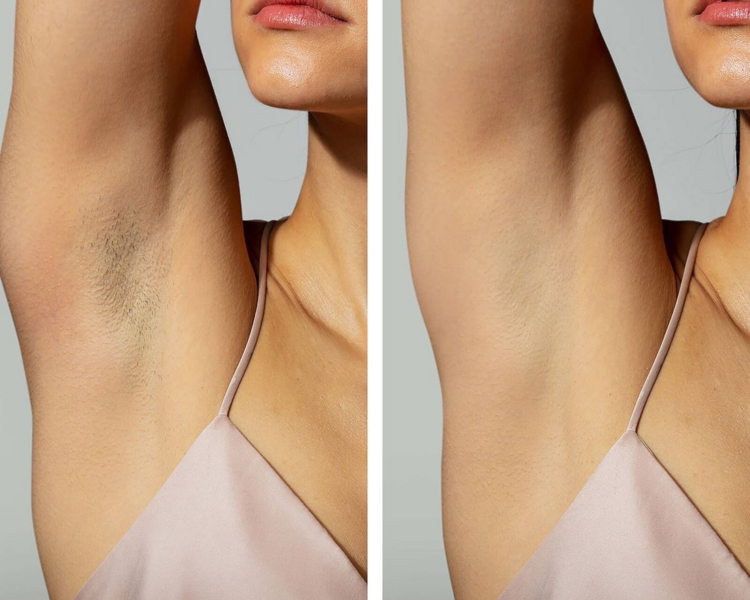 DESPIGMENTACIÓN DE PIEL 