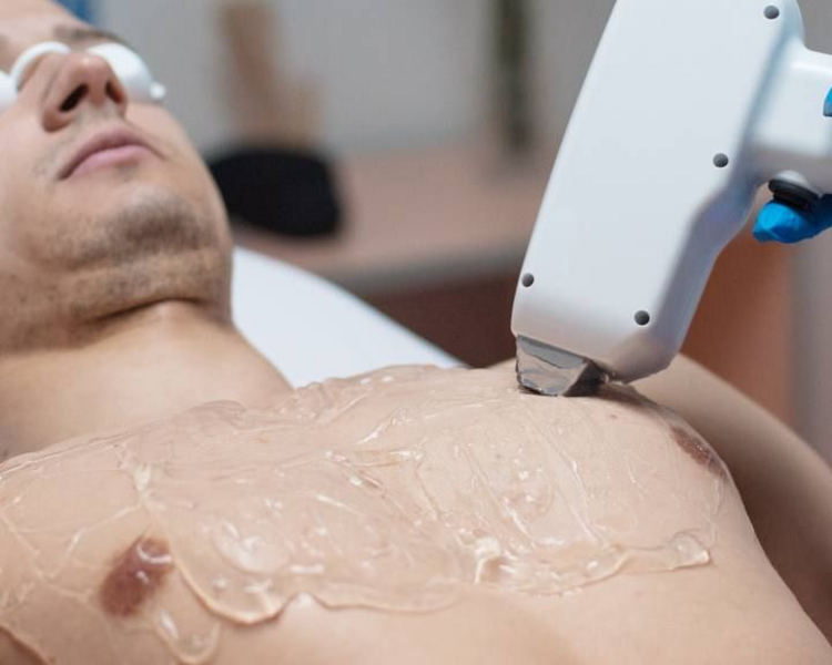 Depilación Láser Zona M+M