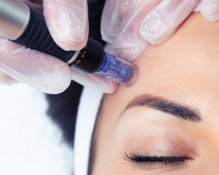MICRONEEDLING (DERMAPEN)