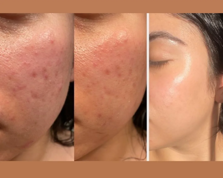 1 sesion Peeling quimico Despigmentante