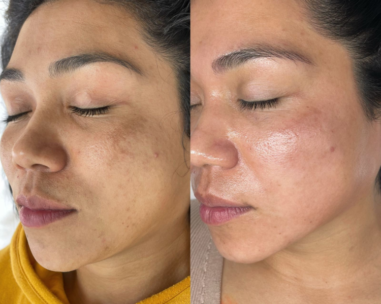 Peeling de Algas Zena + Plasma rico en plaquetas + Revitalización de la piel