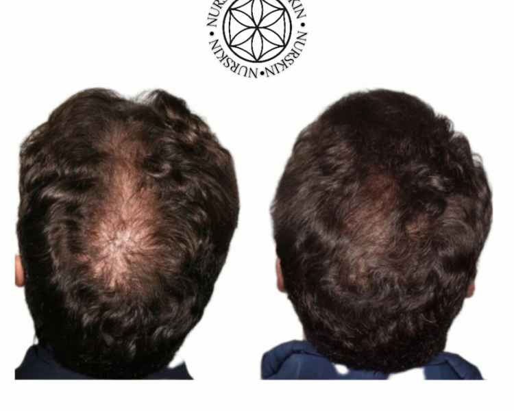 Plasma rico en plaquetas Capilar (4 sesiones)