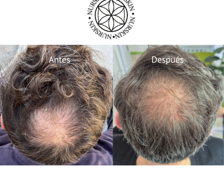 Plasma Capilar + PDNR (semen de salmón) (1 sesión)