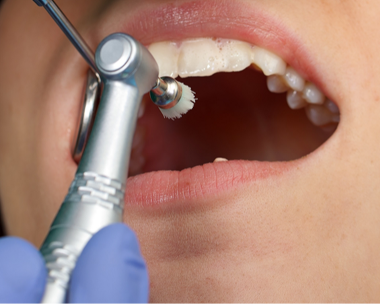 Profilaxis + Blanqueamiento (1 aplicación)