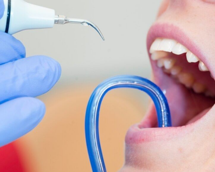 Profilaxis + Limpieza profesional + Blanqueamiento (1 aplicación) + Irrigador de regalo