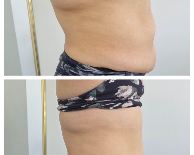 HIFU ABDOMEN + HECCUS TURBO 