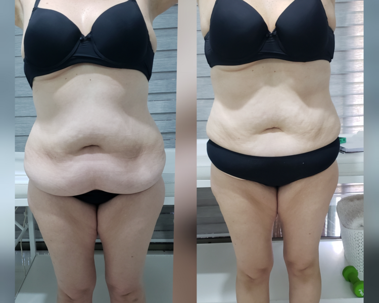 Carboxiterapia + Heccus Turbo con activacion Muscular o Drenaje Linfatico o RaDIOFRECUENCIA