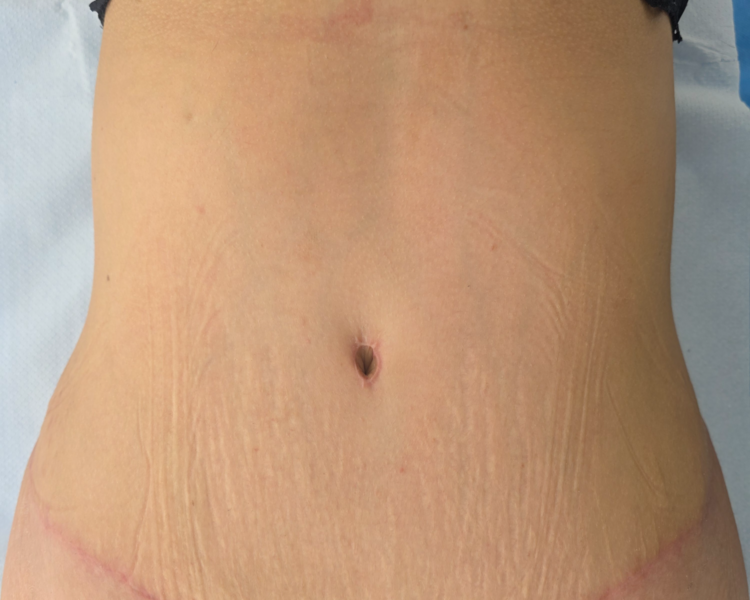 POST OPERATORIO  ABDOMINOPLASTIA BONO PAD 