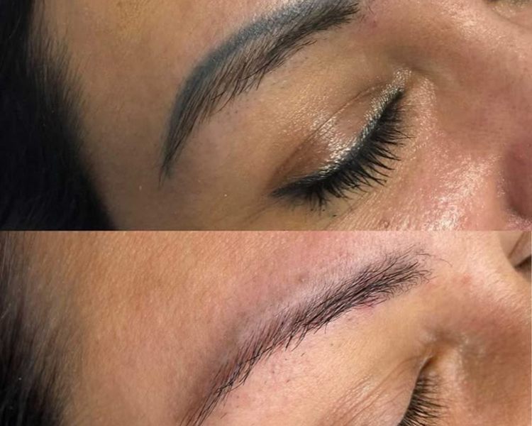 Eliminación de Micropigmentación (1 sesión)