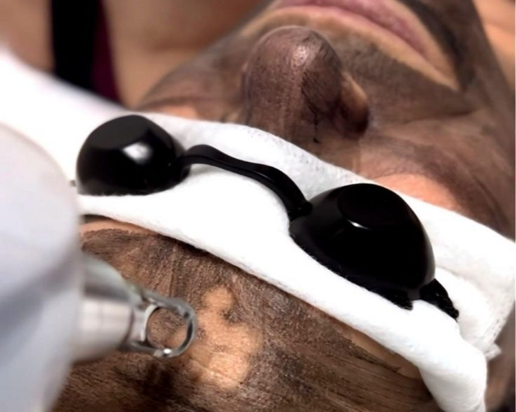 Láser Hollywood Peel (1 sesión)