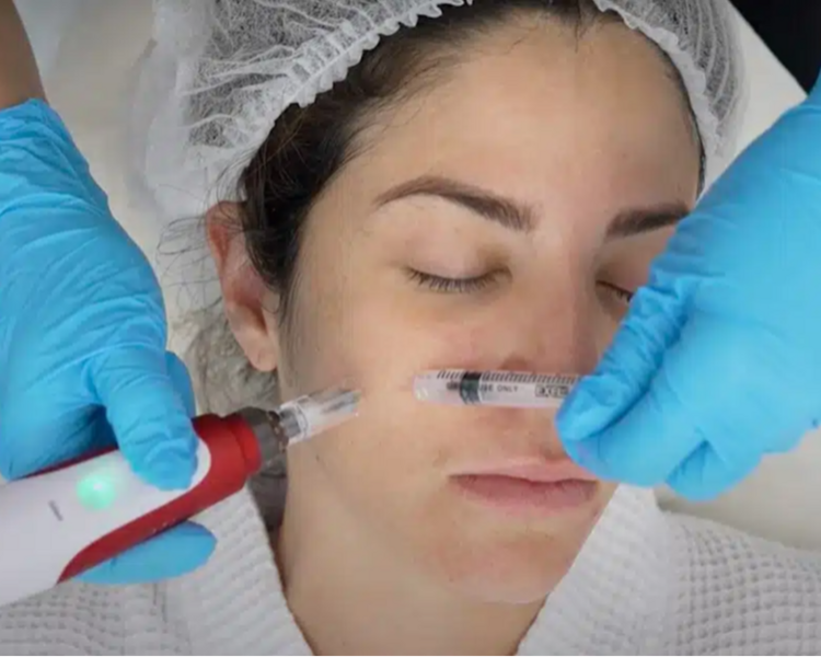 Hollywood Peel + Exosomas 💆🏽♂️🧬💎