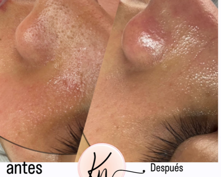 Limpieza facial profunda