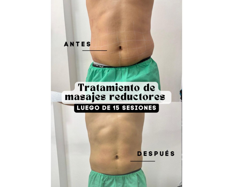 Tratamiento  Corporal 15 sesiones