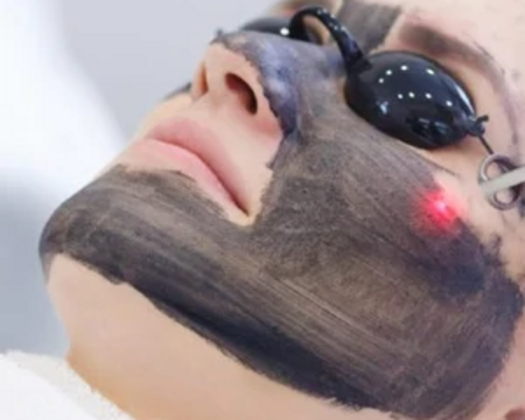 Hollywood peel (laser ND YAG) trionda