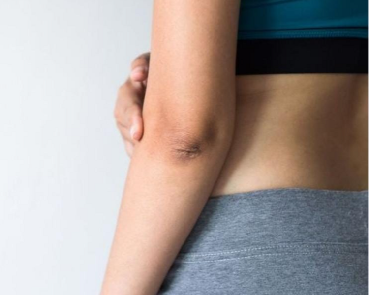 PEELING DESPIGMENTANTE EN AXILAS (BLANQUEADOR)