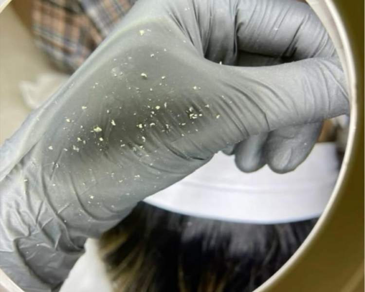 EXTRACCIÓN DE COMEDONES (PUNTOS NEGROS) + LIMPIEZA FACIAL