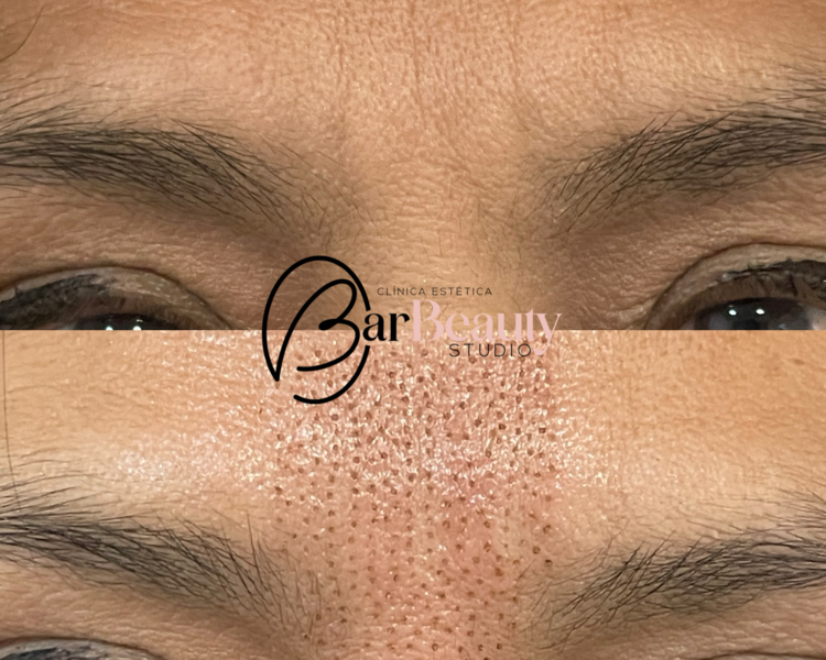 Fibroblast Entrecejo 