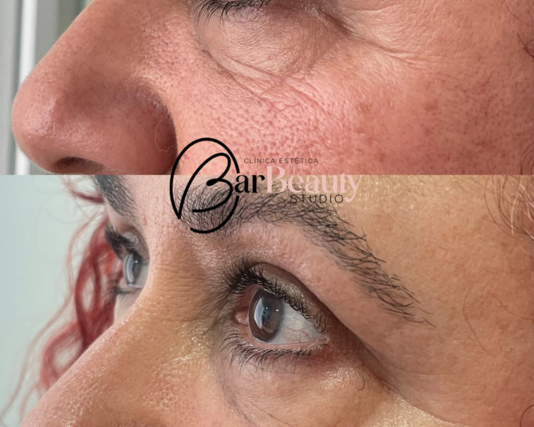Fibroblast contorno de ojos completo 