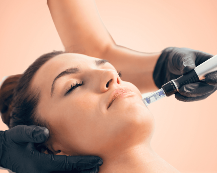 Tratamiento de Estimulación del Colágeno (Dermapen + Ácido Hialurónico) - 1 Sesión