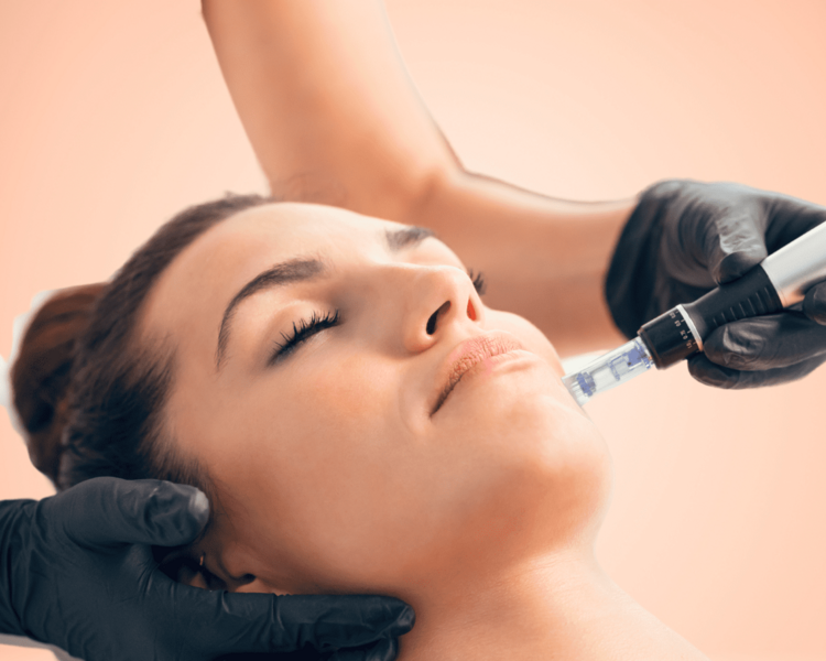 Tratamiento de Estimulación del Colágeno (Dermapen + Ácido Hialurónico) - Pack 3 Sesiones