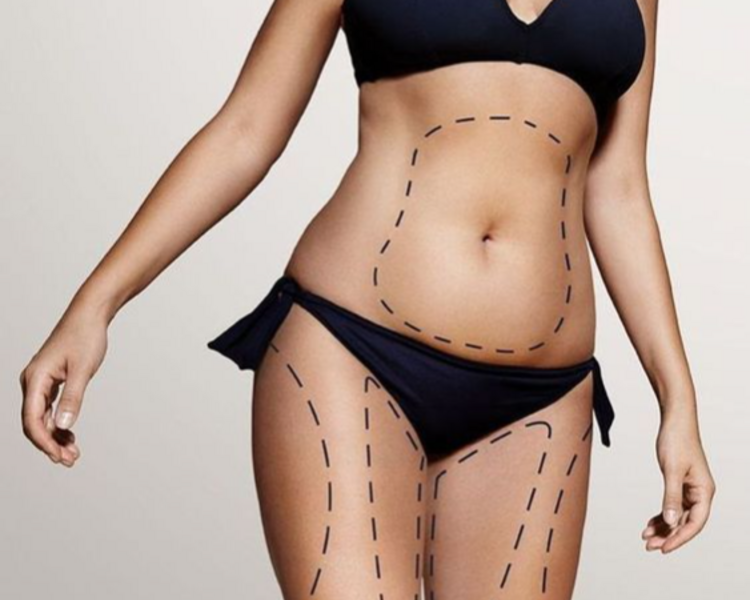 1.Tratamiento Reductor: Indicado para Adiposidad Localizada.