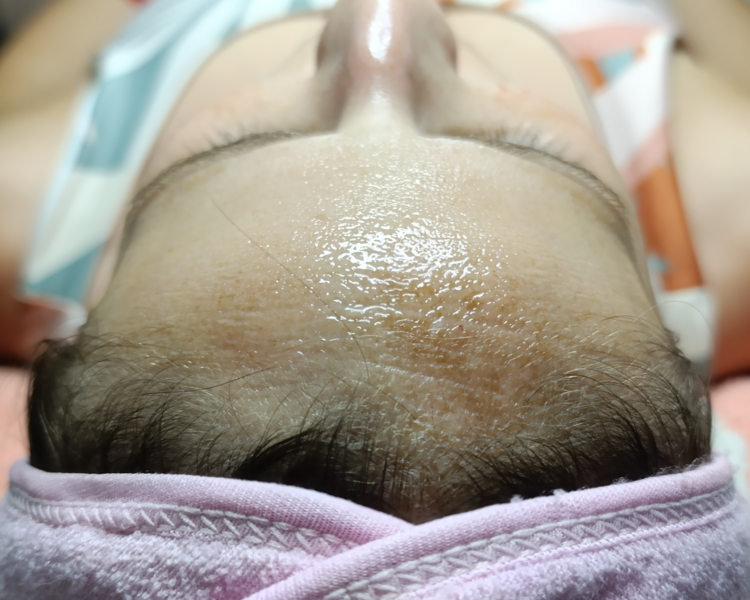 Reverse Peel (Peeling)