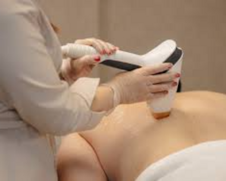 DEPILACION LASER ESPALDA