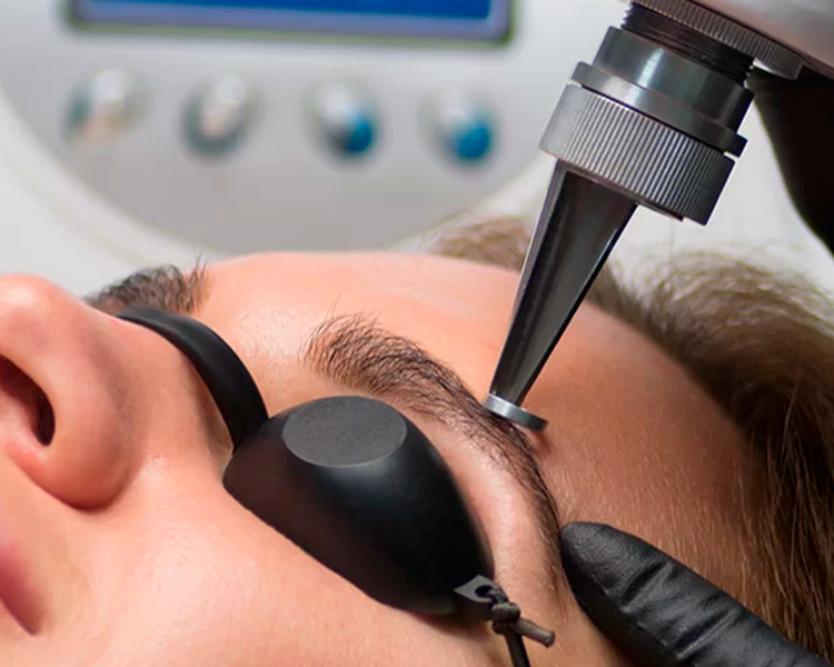 ELIMINACION DE MICROBLADING 3 SESIONES