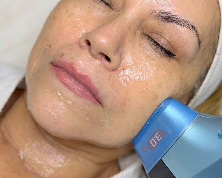 HIFU 12D MAX FACIAL