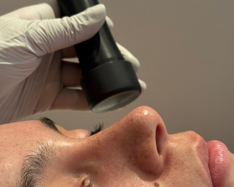 Microneedling facial  PROMOCIÓN