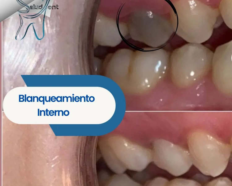 Blanqueamiento  Dental + Limpieza Dental