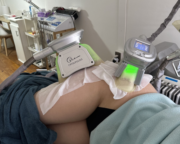 1 Sesión Criolipólisis 4 manípulos