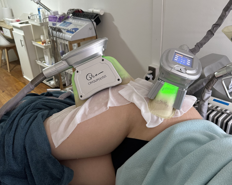 3 Sesiones Criolipólisis 4 manípulos 