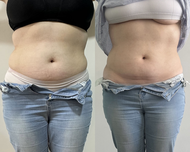 Tratamiento Reductivo Manual