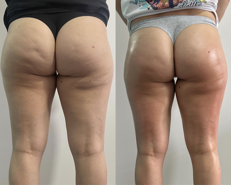 Tratamiento Anticelulítico Reafirmante 