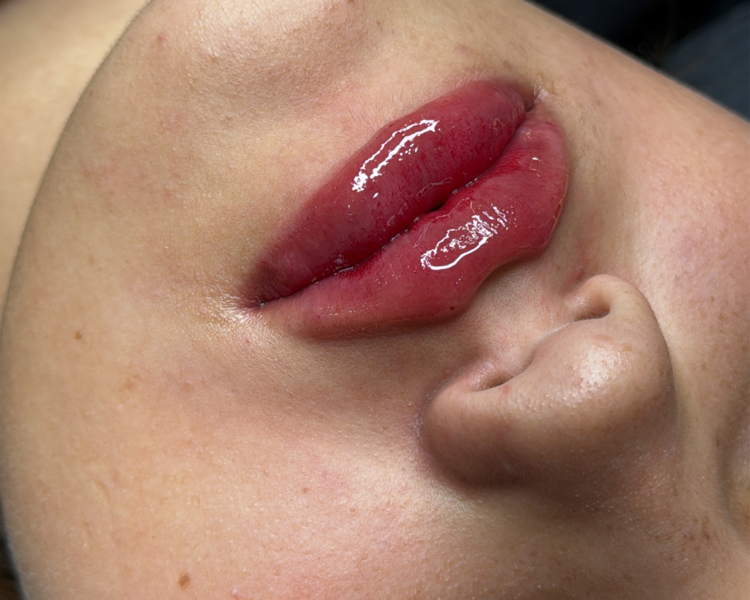 Perfilado de labios con AH