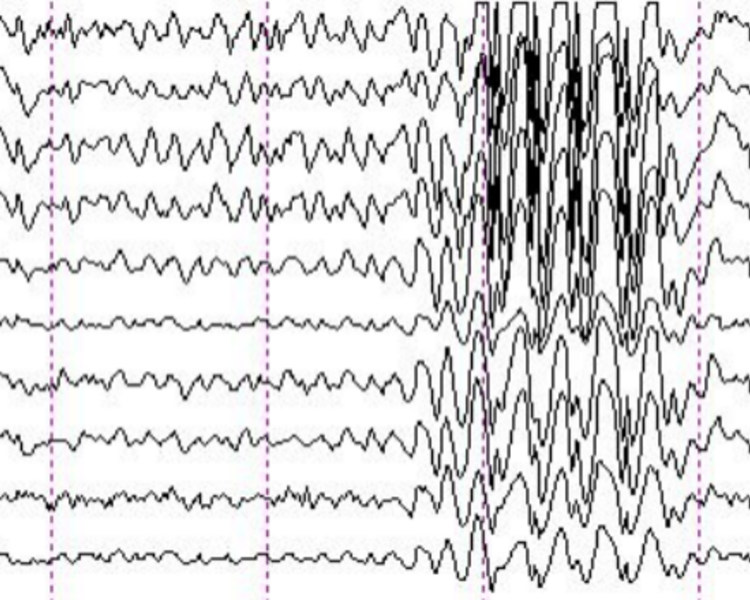 Electroencefalografía (EEG) (requiere 8 h de ayuno)