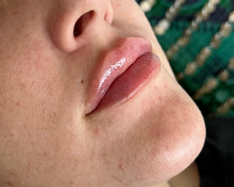 RELLENO DE LABIOS (1 JERINGA)