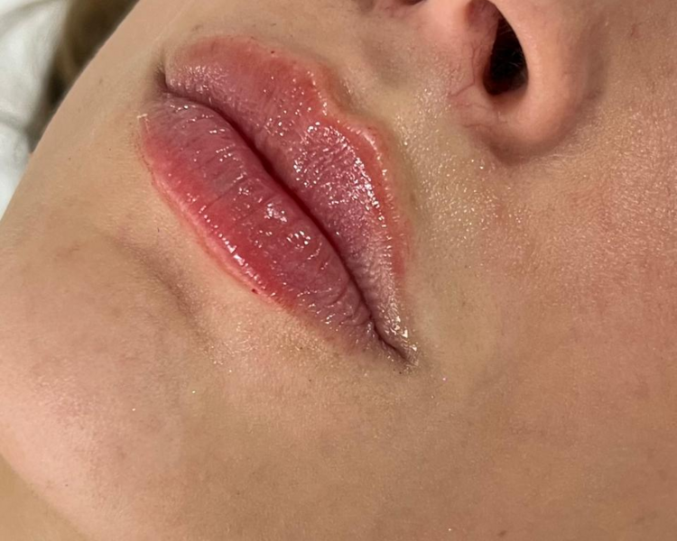 RELLENO DE LABIOS (MEDIA JERINGA)