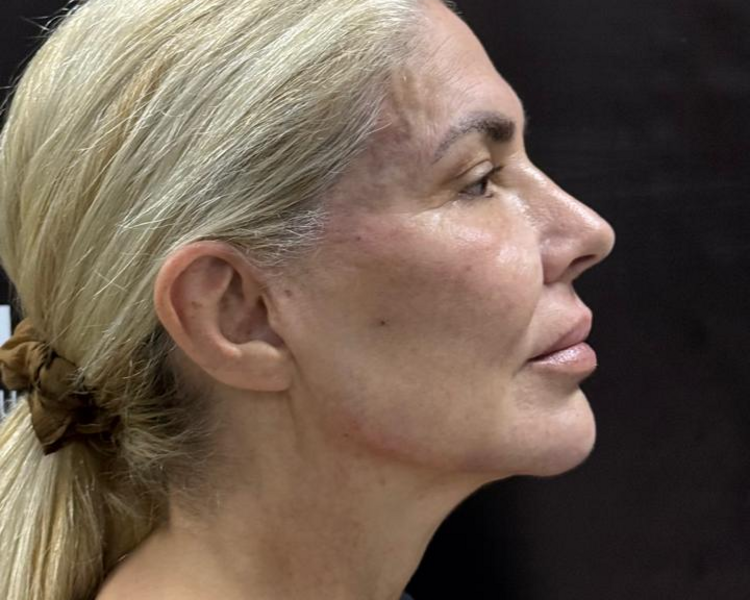 MARCACIÓN MANDIBULAR