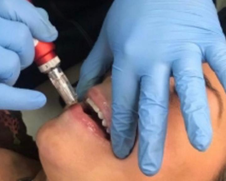 MICRONEEDLING +HYDRA LIPS DERMAPEN