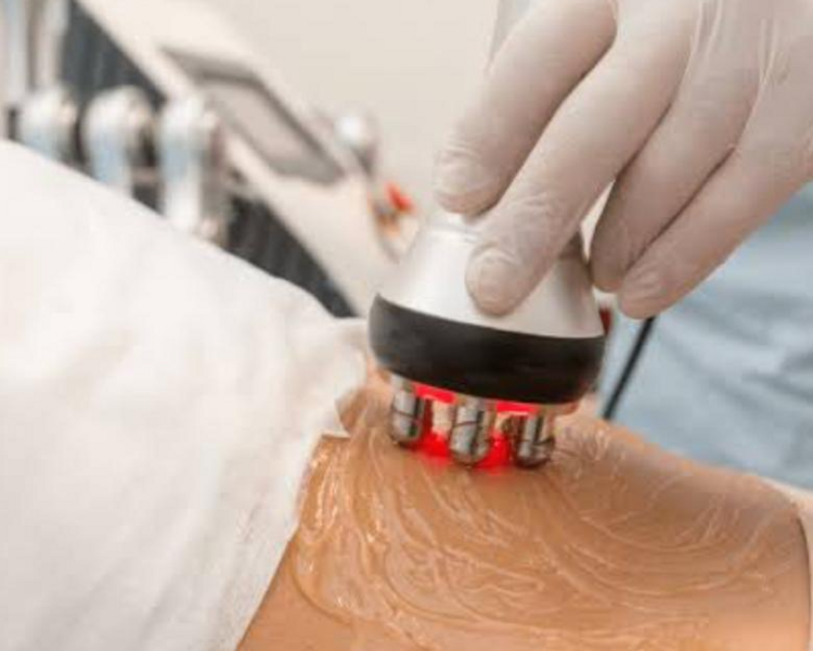 RADIOFRECUENCIA CORPORAL