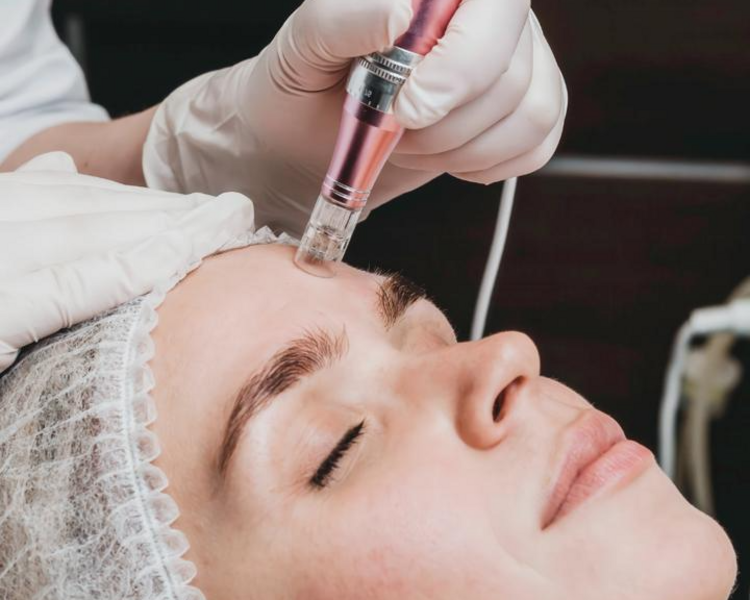 MICRONEEDLING FACIAL (DERMAPEN)