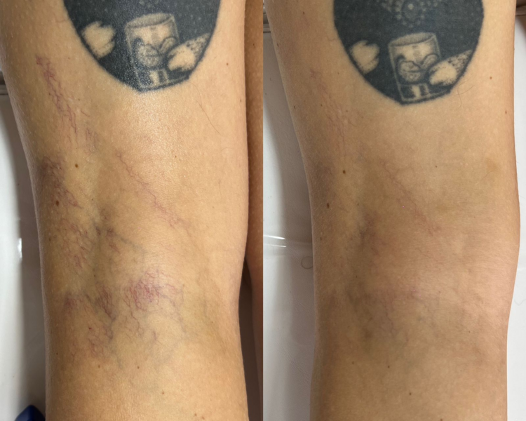 TRATAMIENTO ESCLEROSANTE 