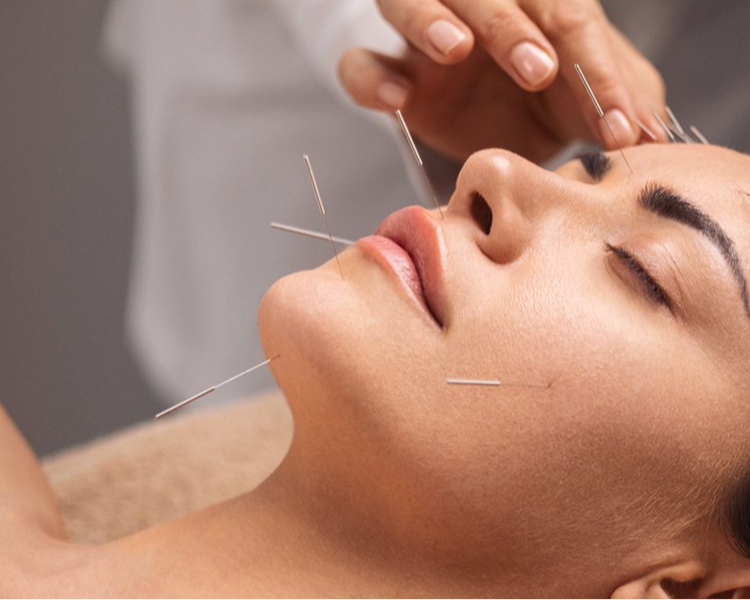 Tratamiento de acupuntura